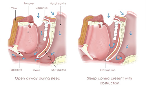 sleep apnea